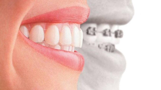 What To Expect During Root Canal Therapy What To Expect During Root Canal Therapy